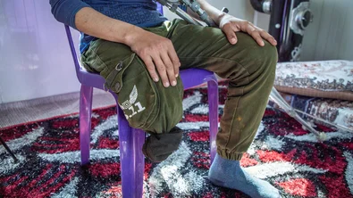 Kind uit Gaza met geamputeerd onderbeen