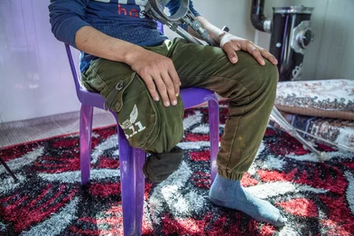 Kind uit Gaza met geamputeerd onderbeen